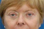 Eyelid (Blepharoplasty)