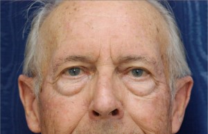 Eyelid (Blepharoplasty) Case 3697 Before Photo Eyelid (Blepharoplasty)