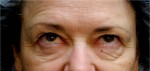 Eyelid (Blepharoplasty)