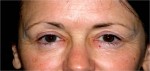 Eyelid (Blepharoplasty)