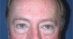 Eyelid (Blepharoplasty)