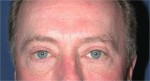 Eyelid (Blepharoplasty)