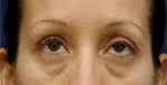 Eyelid (Blepharoplasty)