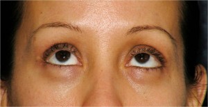 Eyelid (Blepharoplasty) Case 3713 After Photo Eyelid (Blepharoplasty)