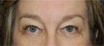 Eyelid (Blepharoplasty)