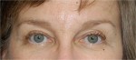 Eyelid (Blepharoplasty)