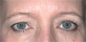 Eyelid (Blepharoplasty) Case 3733 Before Photo Eyelid (Blepharoplasty)