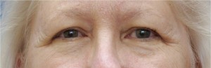 Eyelid (Blepharoplasty) Case 3745 Before Photo Eyelid (Blepharoplasty)