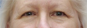 Eyelid (Blepharoplasty)