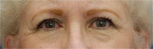Eyelid (Blepharoplasty) Case 3745 After Photo Eyelid (Blepharoplasty)