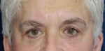 Eyelid (Blepharoplasty)