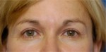 Eyelid (Blepharoplasty)
