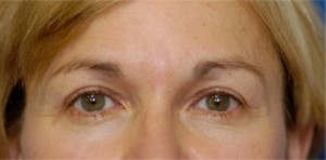 Eyelid (Blepharoplasty)