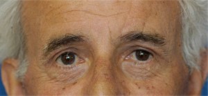 Eyelid (Blepharoplasty)