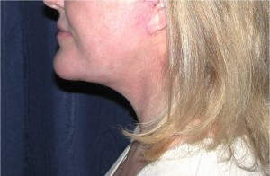 Natural Neck Lift Case 3887 After Photo Natural Neck Lift