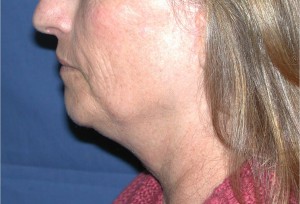 Natural Neck Lift Case 3896 Before Photo Natural Neck Lift