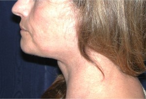 Natural Neck Lift Case 3896 After Photo Natural Neck Lift