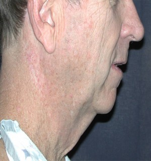 Natural Neck Lift Case 3901 Before Photo Natural Neck Lift