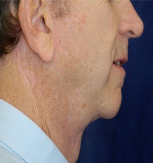 Natural Neck Lift Case 3901 After Photo Natural Neck Lift