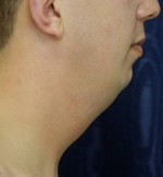 Natural Neck Lift