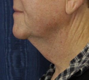 Natural Neck Lift Case 4146 Before Photo Natural Neck Lift
