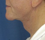 Natural Neck Lift