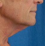 Natural Neck Lift