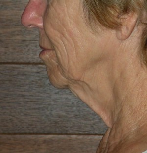 Natural Neck Lift