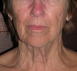 Natural Neck Lift