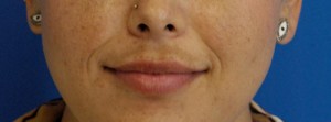 Injectables Case 4331 Before Photo Injectables