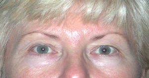 Eyelid (Blepharoplasty) Case 4475 Before Photo Eyelid (Blepharoplasty)