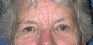 Eyelid (Blepharoplasty) Case 4467 After Photo Eyelid (Blepharoplasty)