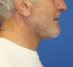 Natural Neck Lift