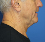 Natural Neck Lift