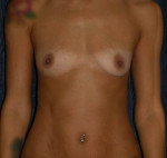 Breast Augmentation