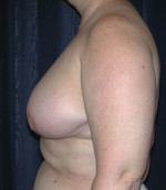 Breast Reduction