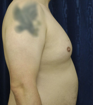 Gynecomastia