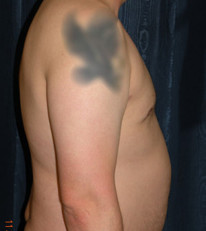 Gynecomastia