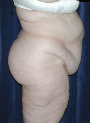 Abdominoplasty