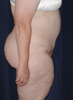 Abdominoplasty