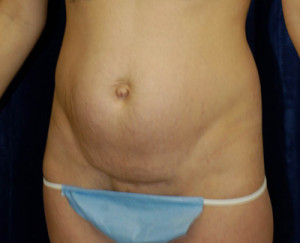 Abdominoplasty