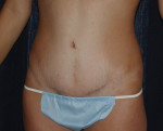 Abdominoplasty