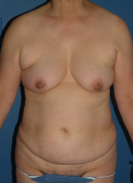 Abdominoplasty