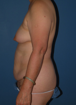 Abdominoplasty Case 4628 Before Photo Abdominoplasty