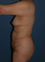 Abdominoplasty