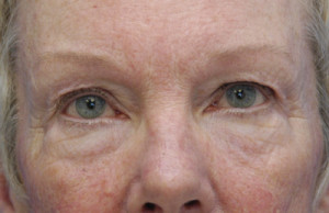 Eyelid (Blepharoplasty)