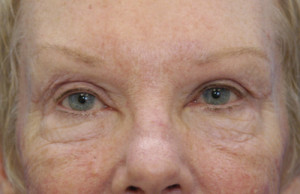 Eyelid (Blepharoplasty)