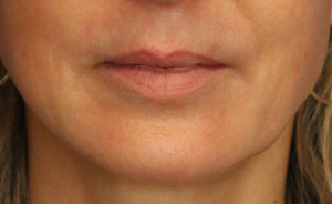 Injectables Case 4666 Before Photo Injectables