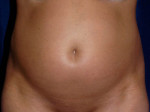 Liposuction