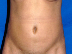 Liposuction Case 4681 After Photo Liposuction